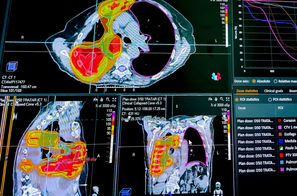 radioterapia-cancer-de-pulmon