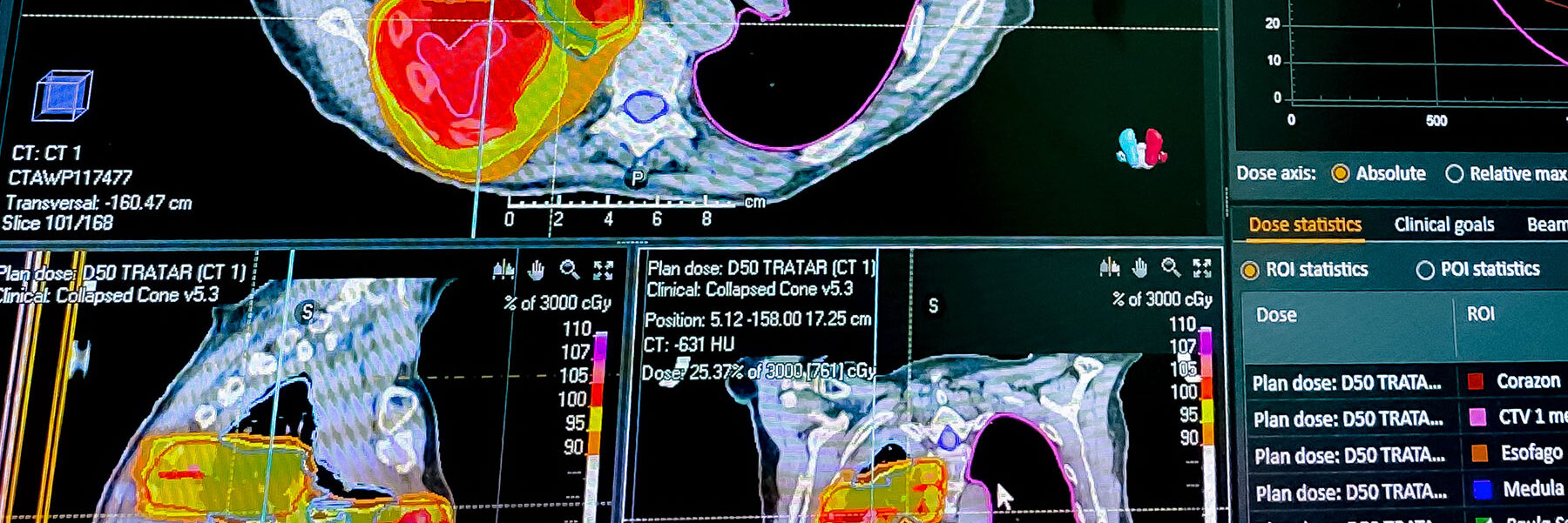 radioterapia-cancer-de-pulmon