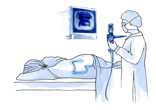 Diagnóstico colitis ulcerosa