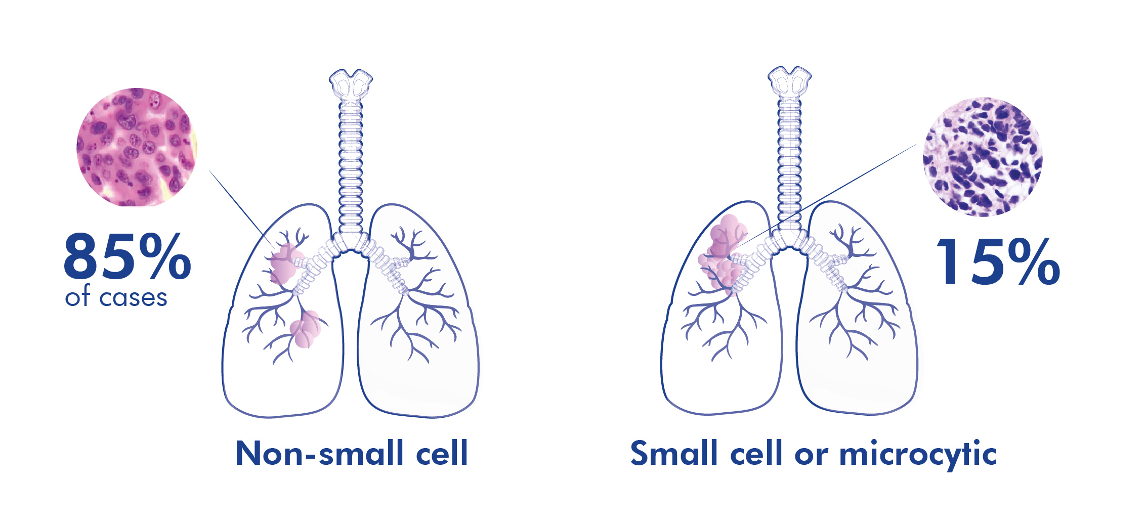 types of lung cancer