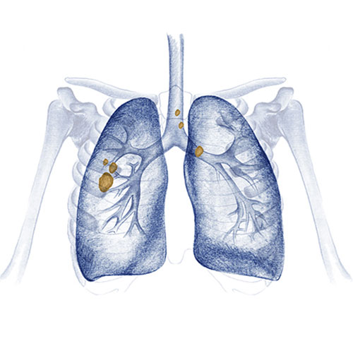 tipos-y-estadio cancer de pulmon