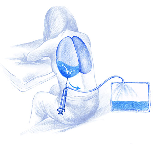 toracentesis