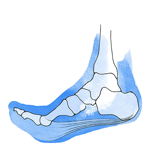 Fascitis plantar