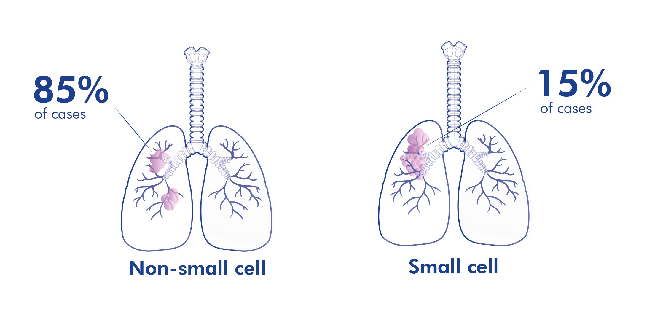 Types of lung cancer