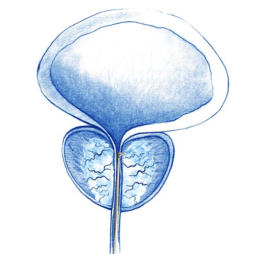 Fotovaporización prostática con láser (FVP)