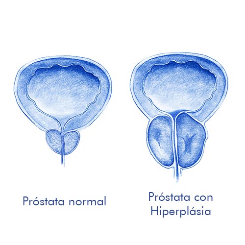 ¿Qué es la hiperplasia benigna de próstata?