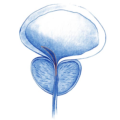 Incisión transuretral de la próstata (ITUP)