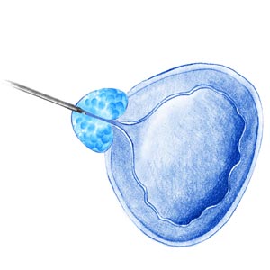 procedimiento enuclación de próstata