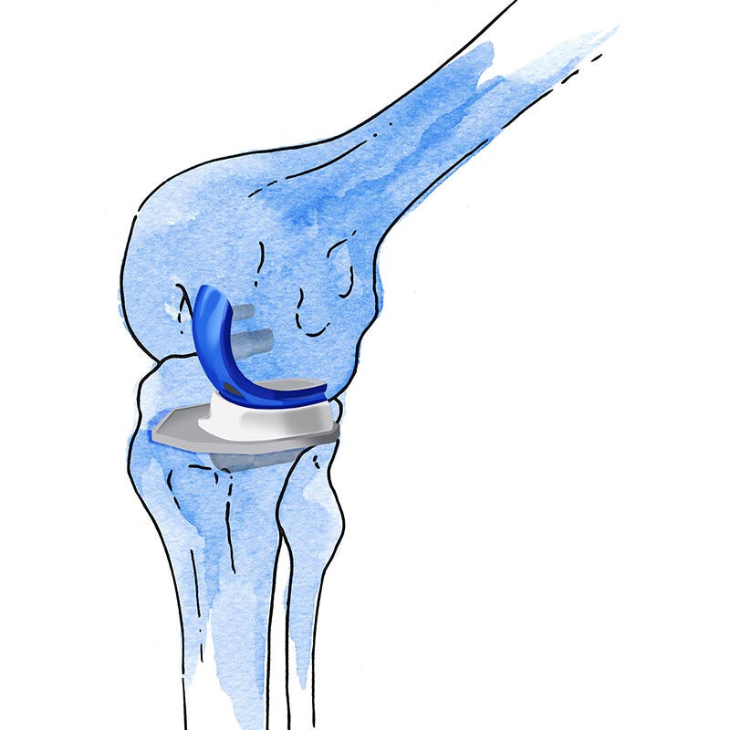 prótesis parcial rodilla