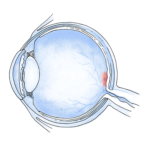 Macular hole