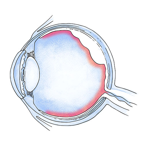 Retinal detachment marbella
