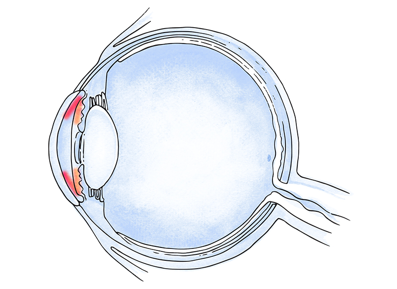 glaucoma