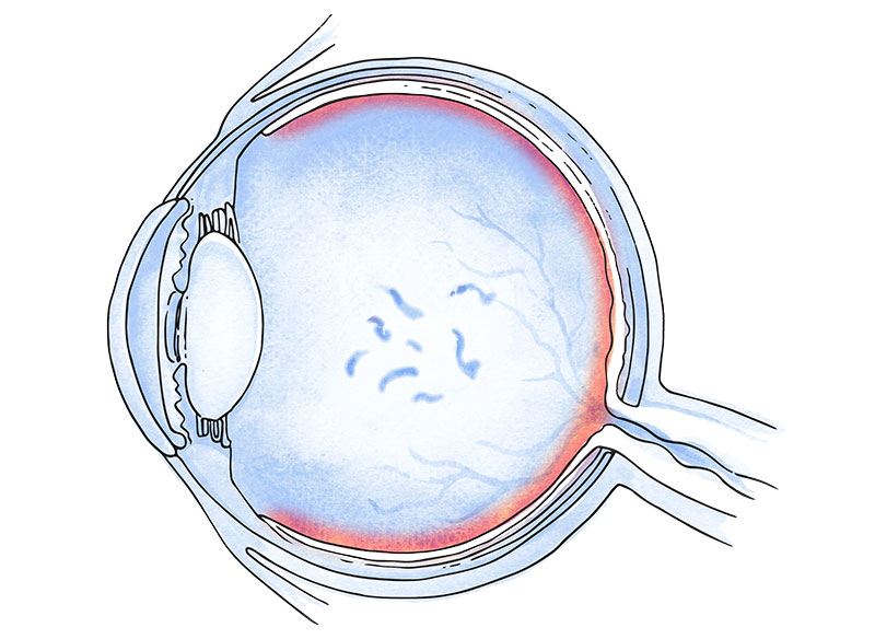 moscas volantes ojo