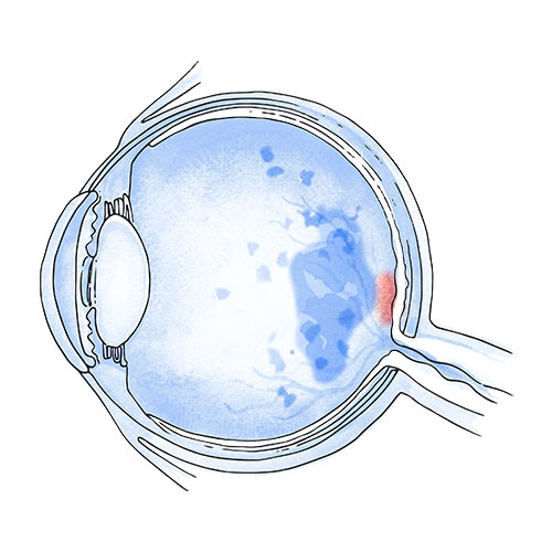 Diabetic retinopathy and diabetic macular oedema