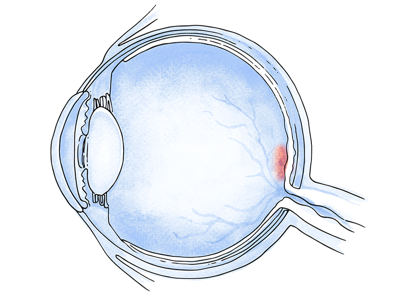 tratamiento agujero macular