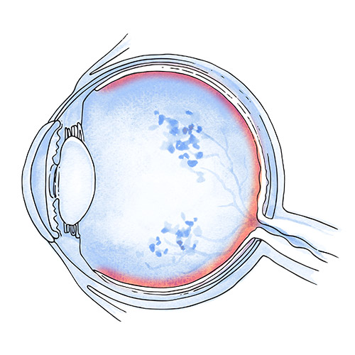 Vascular occlusions