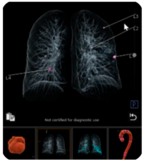 IA para evaluación pulmonar
