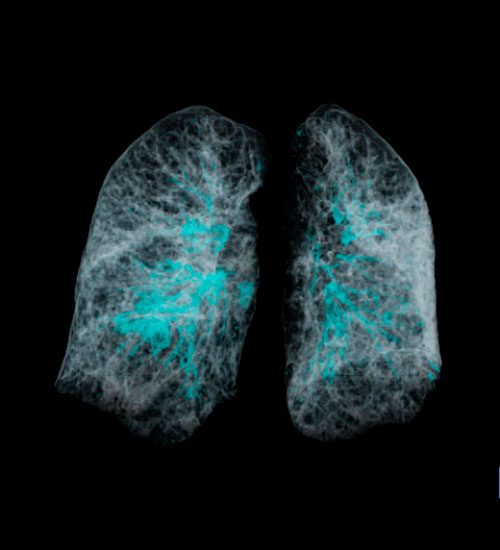 IA para evaluación pulmonar