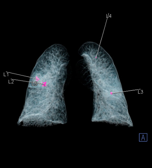 diagnostico de pulmon