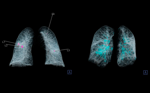 IA TC pulmonar con IA