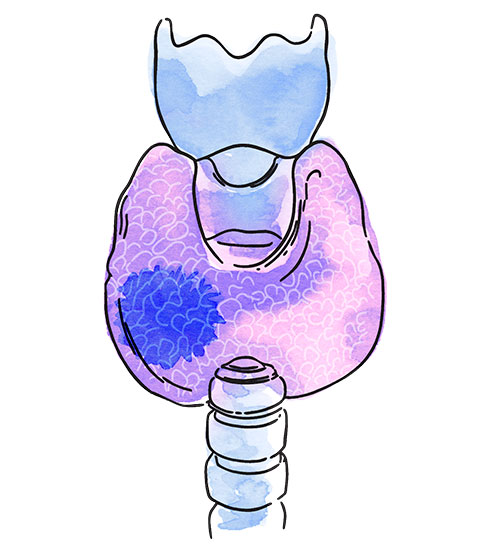 Cáncer de tiroides