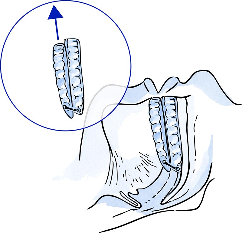 dispositivo de avance mandibular
