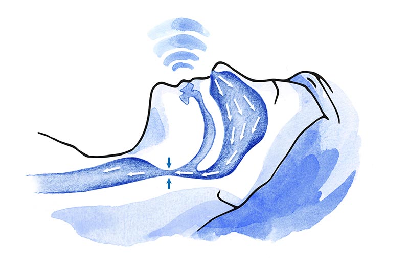 apnea del sueño