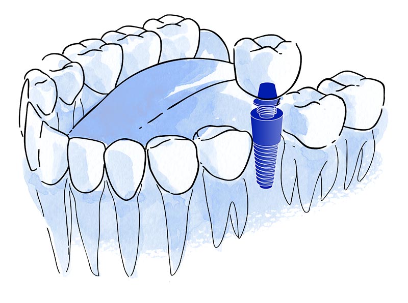 Implantes dentales