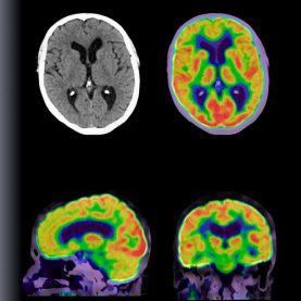 PET TC neurología