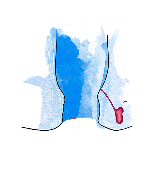Abscesos perianales