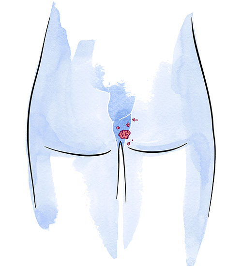 Condilomas anales (VPH)