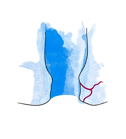 Fístula anal