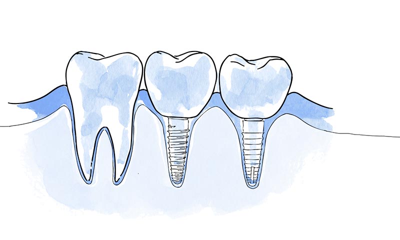 implante dental