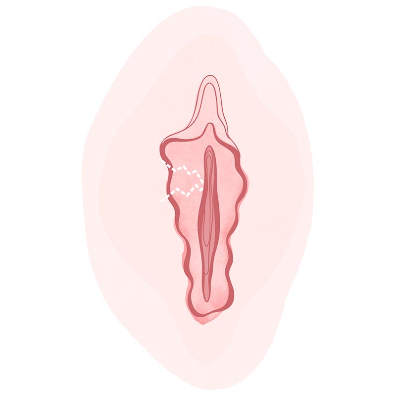 labioplastia Marbella