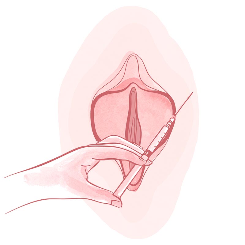neuromodulador ginecología