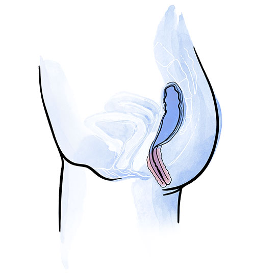 Prolapso rectal