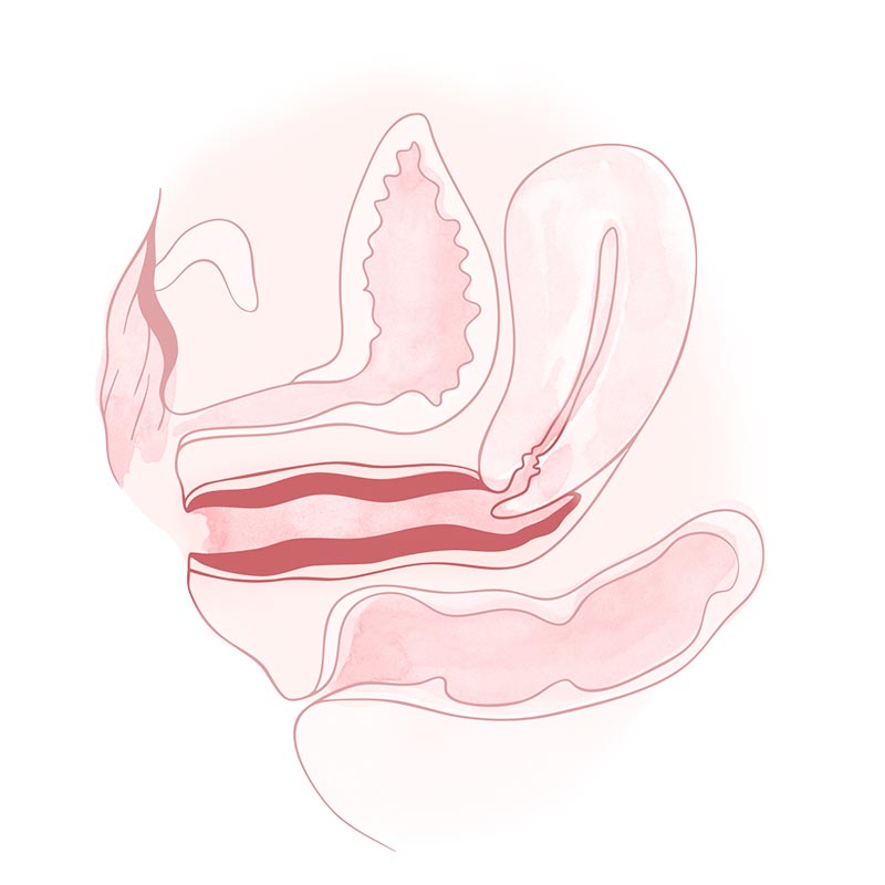 vaginoplastia