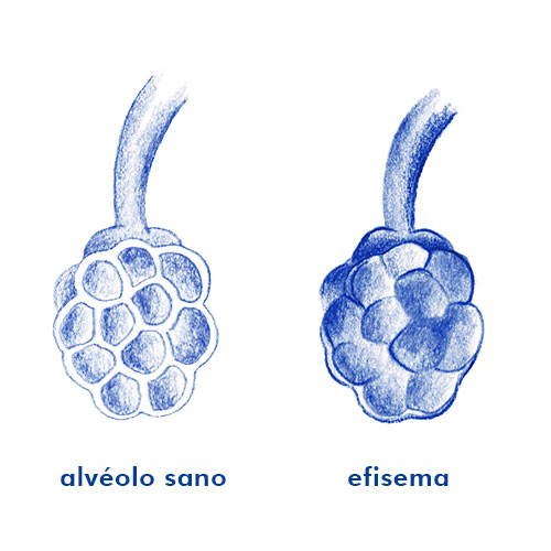 efisema pulmonar