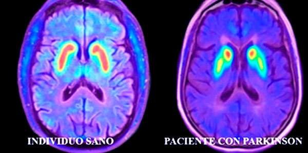 F-DOPA PET/CT Parkinson imaging