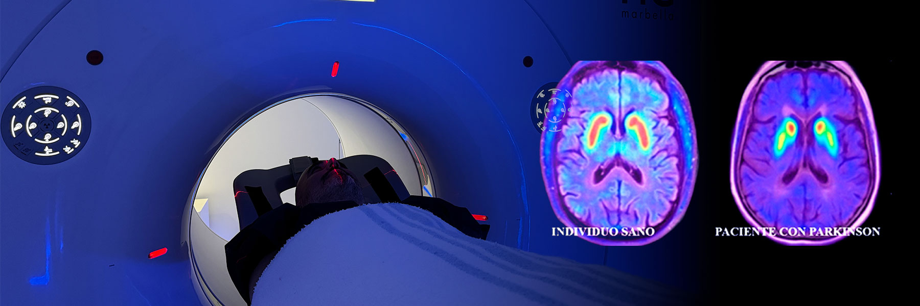 PET/CT scan Parkinson comparison