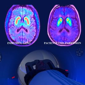 PET/TC en Parkinson: diagnóstico prec...