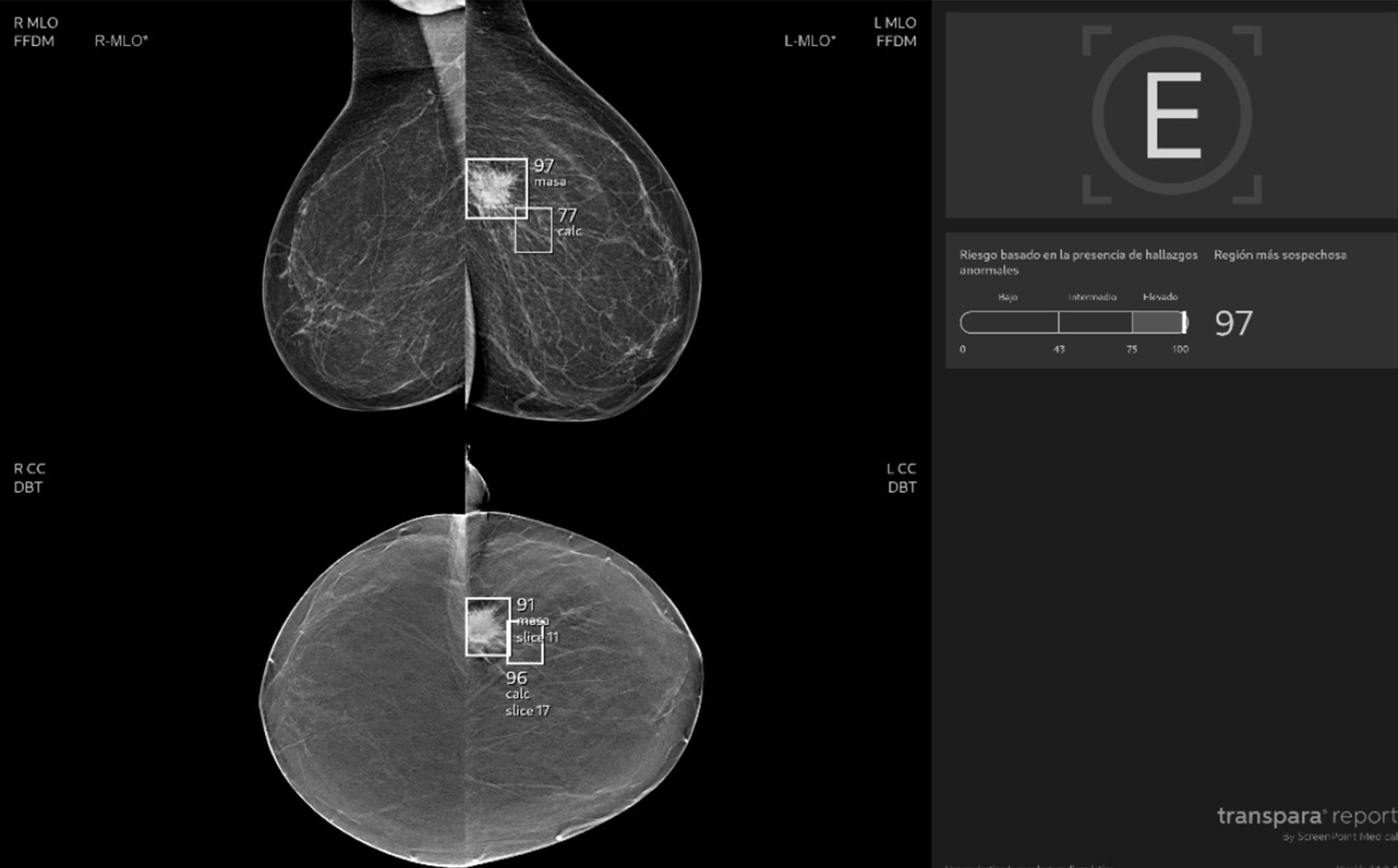 Transpara IA para mamografía